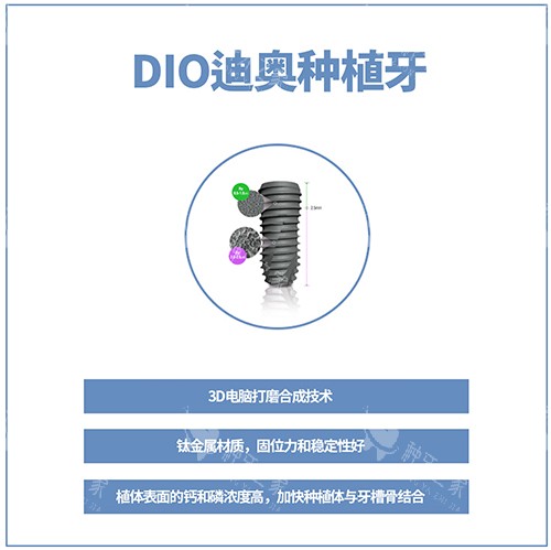 韩国DIO种植牙讲解图