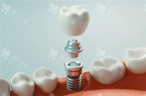 每舒达种植牙是韩国的品牌吗?是的!价格品质都好
