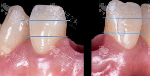 韩系奥齿泰需要多少钱？附奥齿泰植体价格表