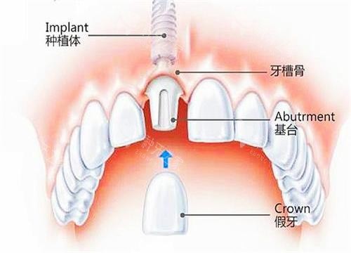 常熟牙科医院排名，牙友整理了种牙排行榜！