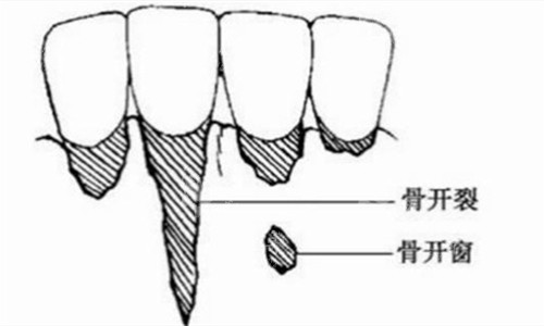 杭州雅莱口腔种植牙价格2025年：2070元起！