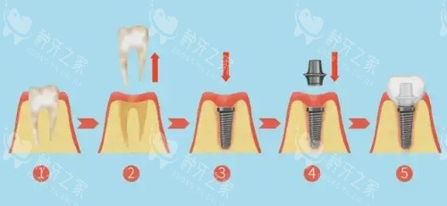 宜春种牙多少钱一颗？半口全口种牙价格表费用大盘点