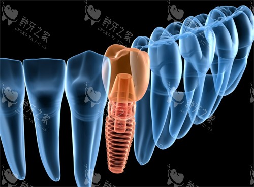 余姚名仕口腔做种牙怎么样？价格、优势、评价您看下！