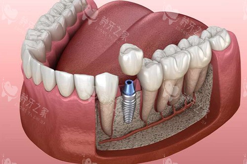 牙槽骨多少mm可以种牙？详解厚度需求附种牙实操建议