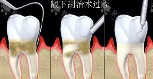 龈下刮治过程
