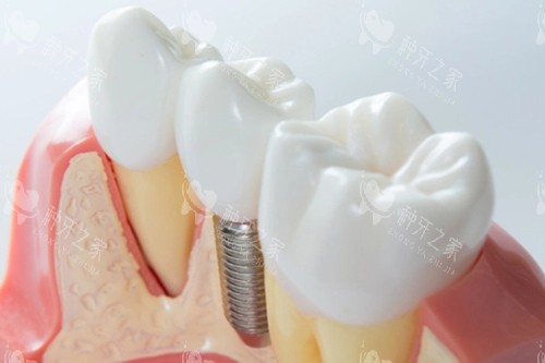 晋城百年口腔种牙怎么样？多个角度解析为您揭晓