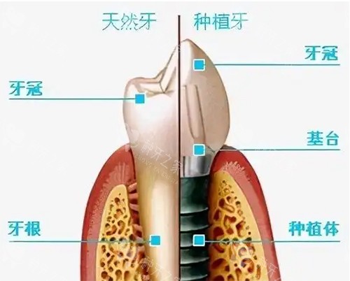 天然牙齿和种植牙对比