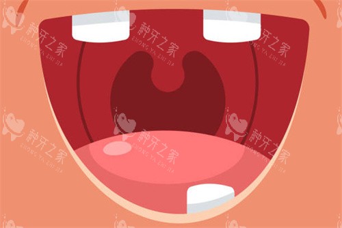 多颗牙缺失怎么种植？方案选择等实用指南奉上！