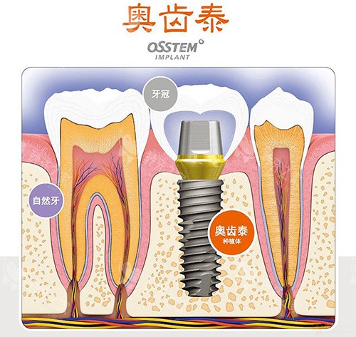 韩国进口种植牙价格表:单颗2980-8000元起