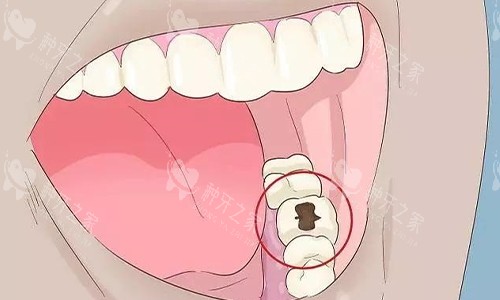 牙齿坏了怎么办