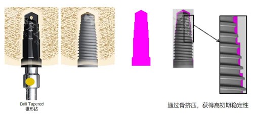 瑞典种植体pcc和pmc哪个好？诺贝尔品牌的不同型号
