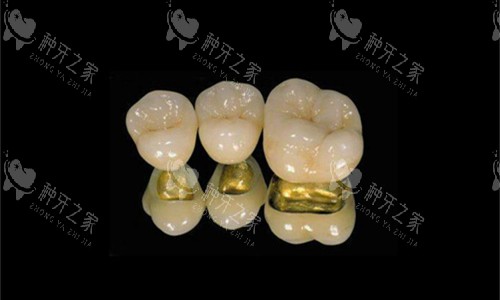 种植牙冠的种类及价格表你了解清楚了吗？