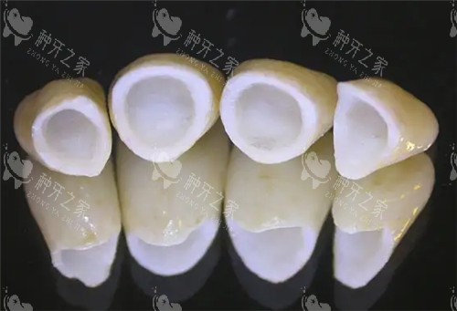 全瓷牙连桥冠照片