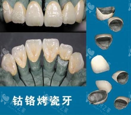 钴铬合金烤瓷牙示意图