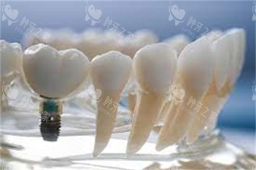 沈阳种牙价格一般多少钱？收费标准三千起需结合多因素！