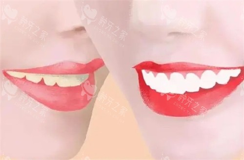 牙齿美白前后对比图