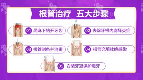 根管治疗的步骤