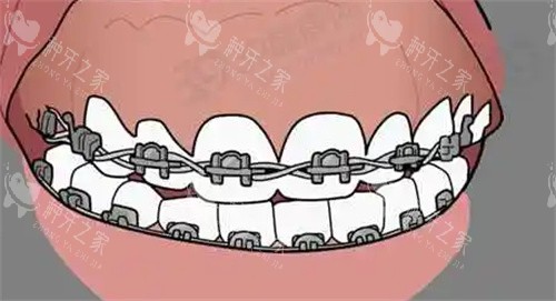 牙齿矫正动画图