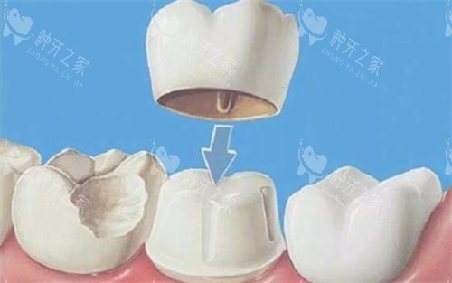 全瓷牙冠安装