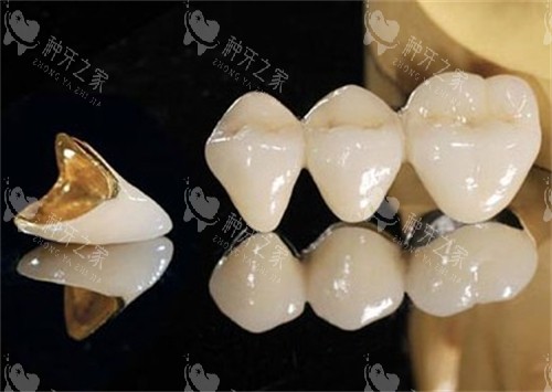 单颗烤瓷牙和连冠烤瓷牙