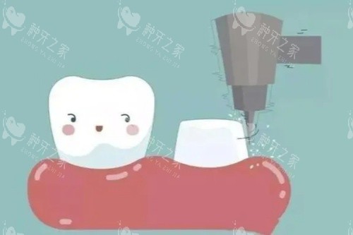 种植牙打桩后要疼几天？影响疼痛时长的因素有哪些