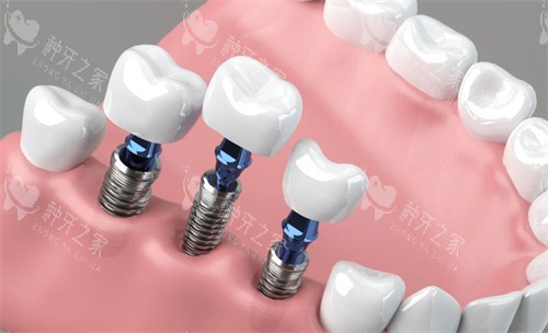 吉安市种牙多少钱一颗？单颗2980+、半口4w+