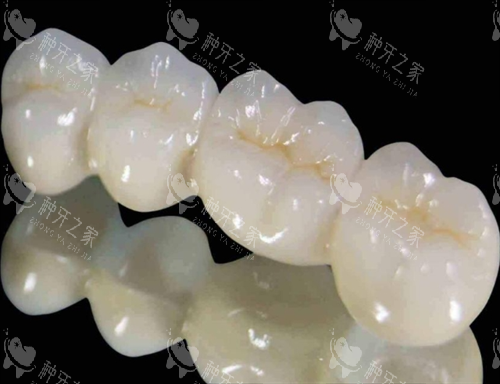 钯金烤瓷牙模型