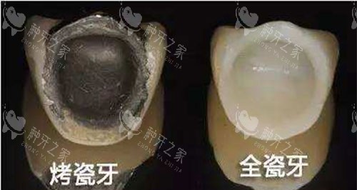 烤瓷牙和全瓷牙展示图
