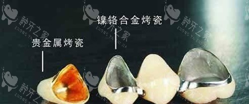 烤瓷牙不同材料示意图