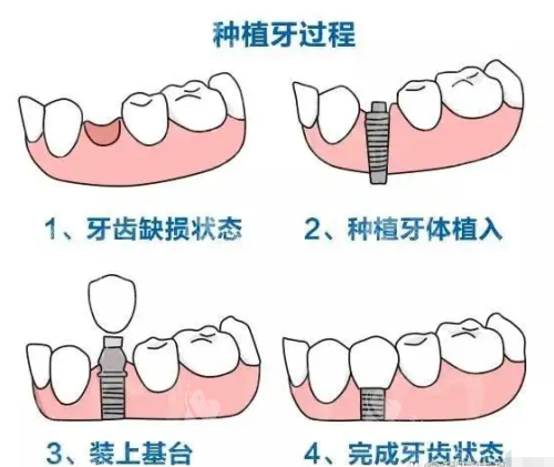 种牙分几步?检查→手术→修复全流程解析