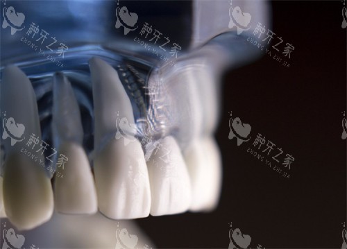 大同恒大口腔种牙动画图示