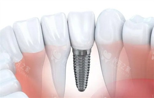 南昌瑞尔口腔种牙技术有名，配备CBCT+3D导板