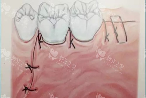 牙龈翻瓣切口卡通示意图