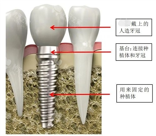 国产新华植体价格表,实惠报价速查