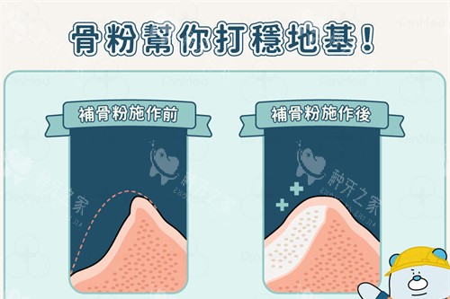 种植牙植骨前后漫画对比图