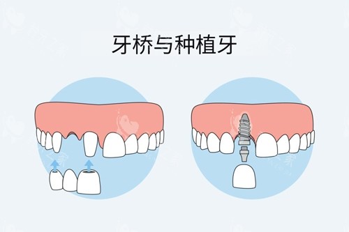 意大利西泰克C-Tech植体价格表,全系列报价