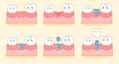 东莞寮步莞大口腔种牙流程示意图