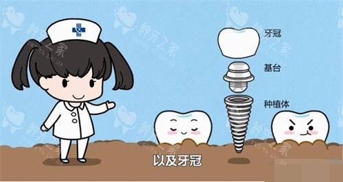 无锡种植牙多少钱一颗？3100元起的收费并不贵