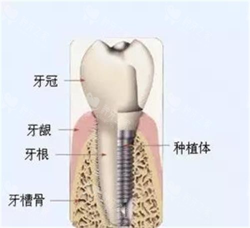 韩国登特斯dentis植体价格表,费用大盘点