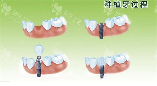 韩国的种植体质量好吗?能用多少年?是不是用不长?