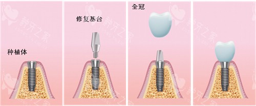 瑞士sic种植牙寿命超10年？档次与价格给出答案