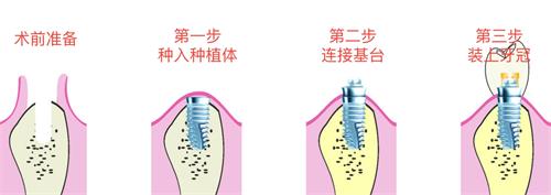 韩国种植牙10大品牌盘点：性价比对比，看完再决定