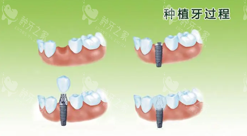 康拓种植牙的优点和缺点是什么？维持时间、价格全解析