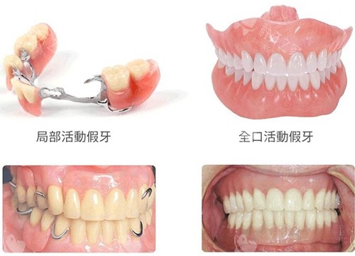 假牙多种方式展示