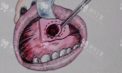 上颌窦穿孔的动画图