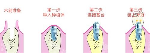 种植牙的步骤