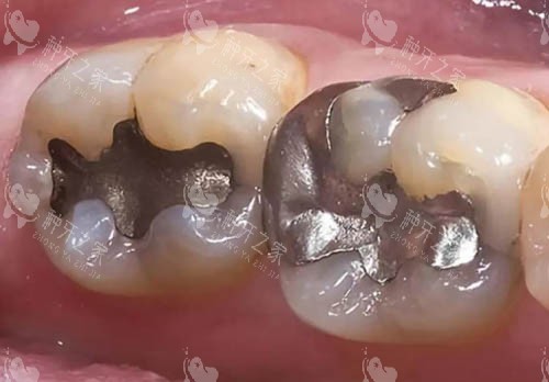 金属材料补牙细节图
