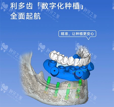 利多齿种植牙怎么样