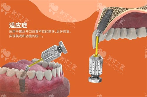 百齿泰植体适应症展示图