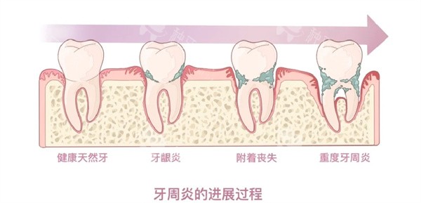 牙周炎